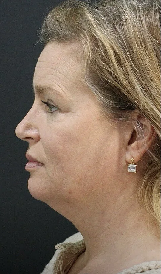 A patient of Dr. Quiroz before her neck lift, in profile: the six anatomic findings live in this frame.