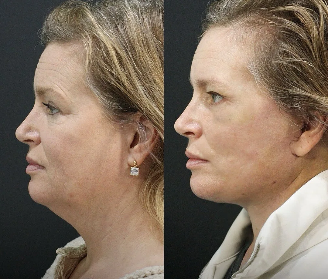 A patient before and after a face and neck lift + lower eyelid surgery by Dr. Quiroz. Individual results vary.