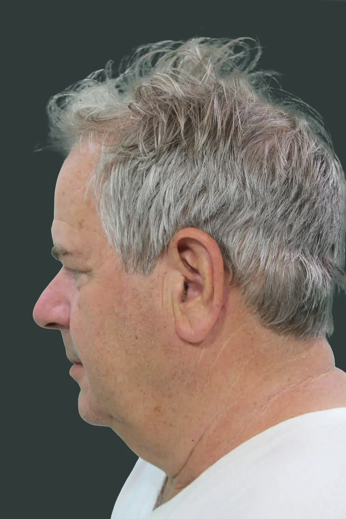 A patient before a deep plane face and neck lift with Dr. Quiroz