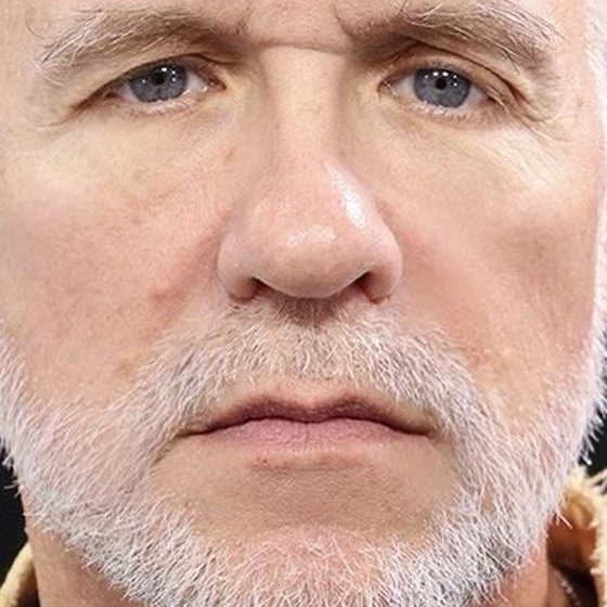 The same jawline after a deep plane facelift by Dr. Quiroz, the structural change a device cannot make